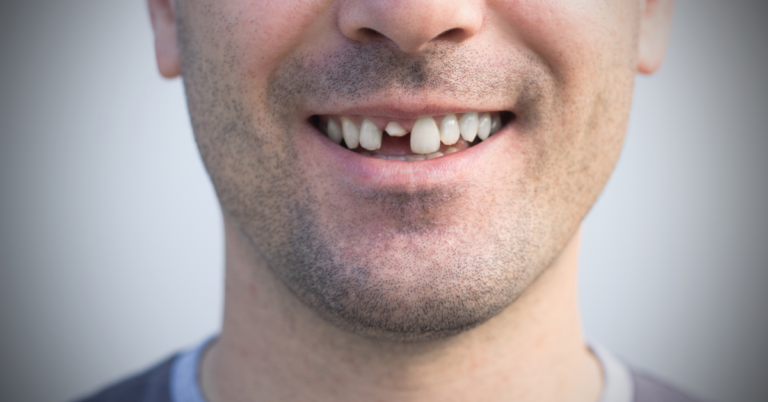 The Hidden Dangers of DIY Dentistry